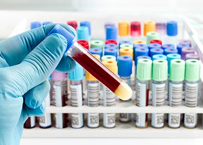Global Análisis de sangre Informe de mercado 2020 con coronavirus (COVID-19) Análisis de efectos y posicionamiento en la industria de proveedores clave : Abbott Laboratories, Bio-Rad Laboratories, F. Hoffmann La Roche